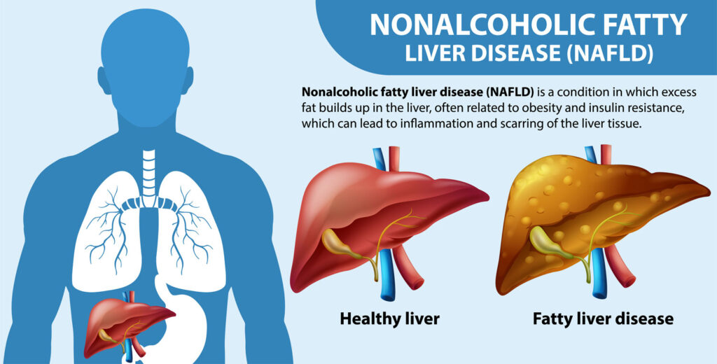 infographic on fatty liver disease